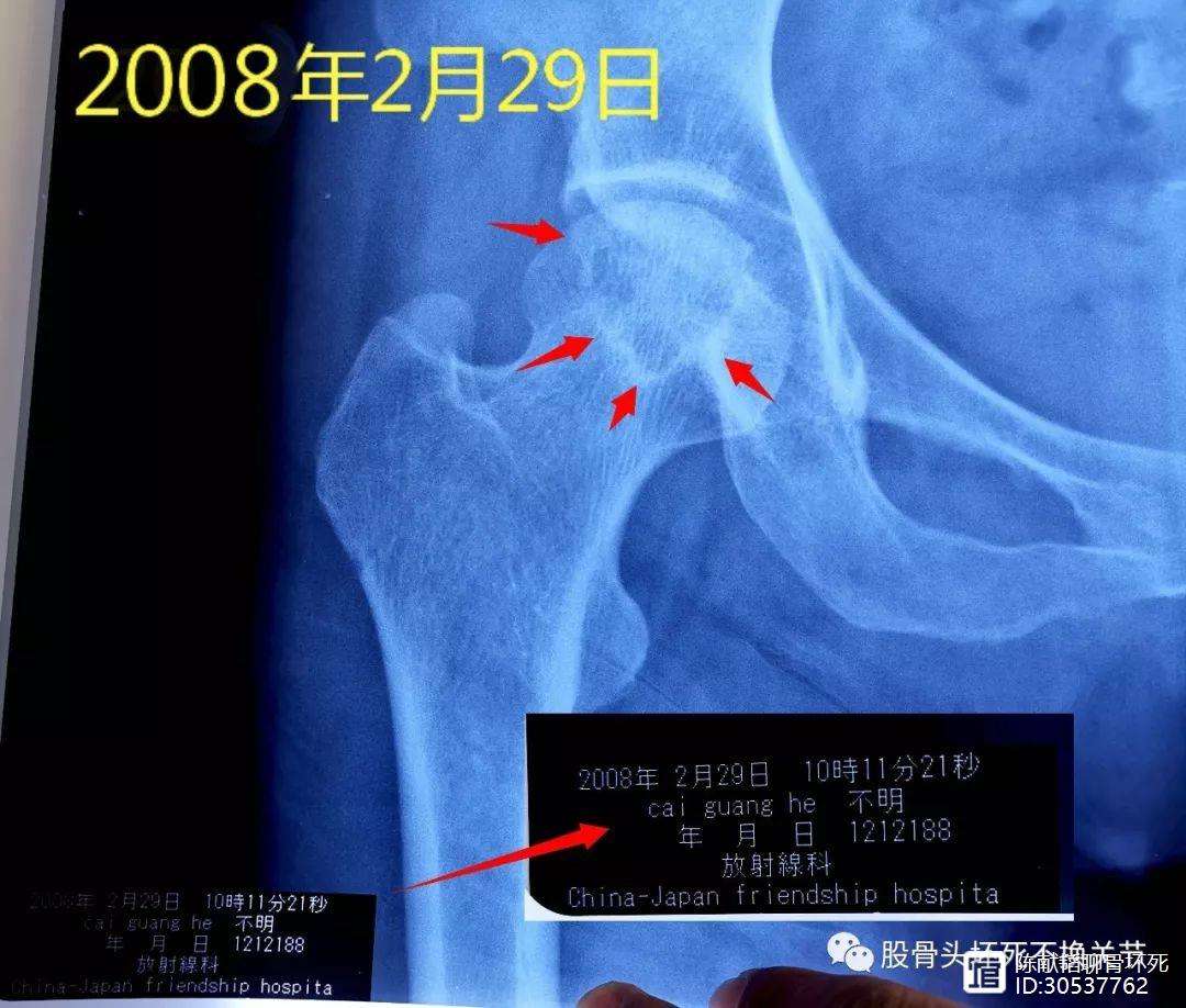 齐齐哈尔人工骨头医保报销多少(人工骨头医保报销多少比例)